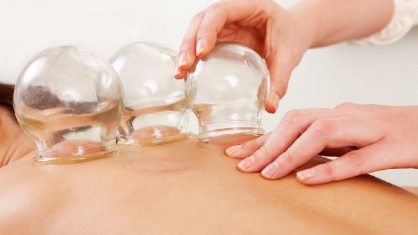 Fotografia de uma mulher recebendo a terapia das ventosas